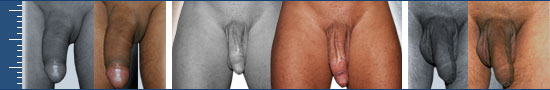 Výsledky zvětšní penisu | AndroPenis.cz